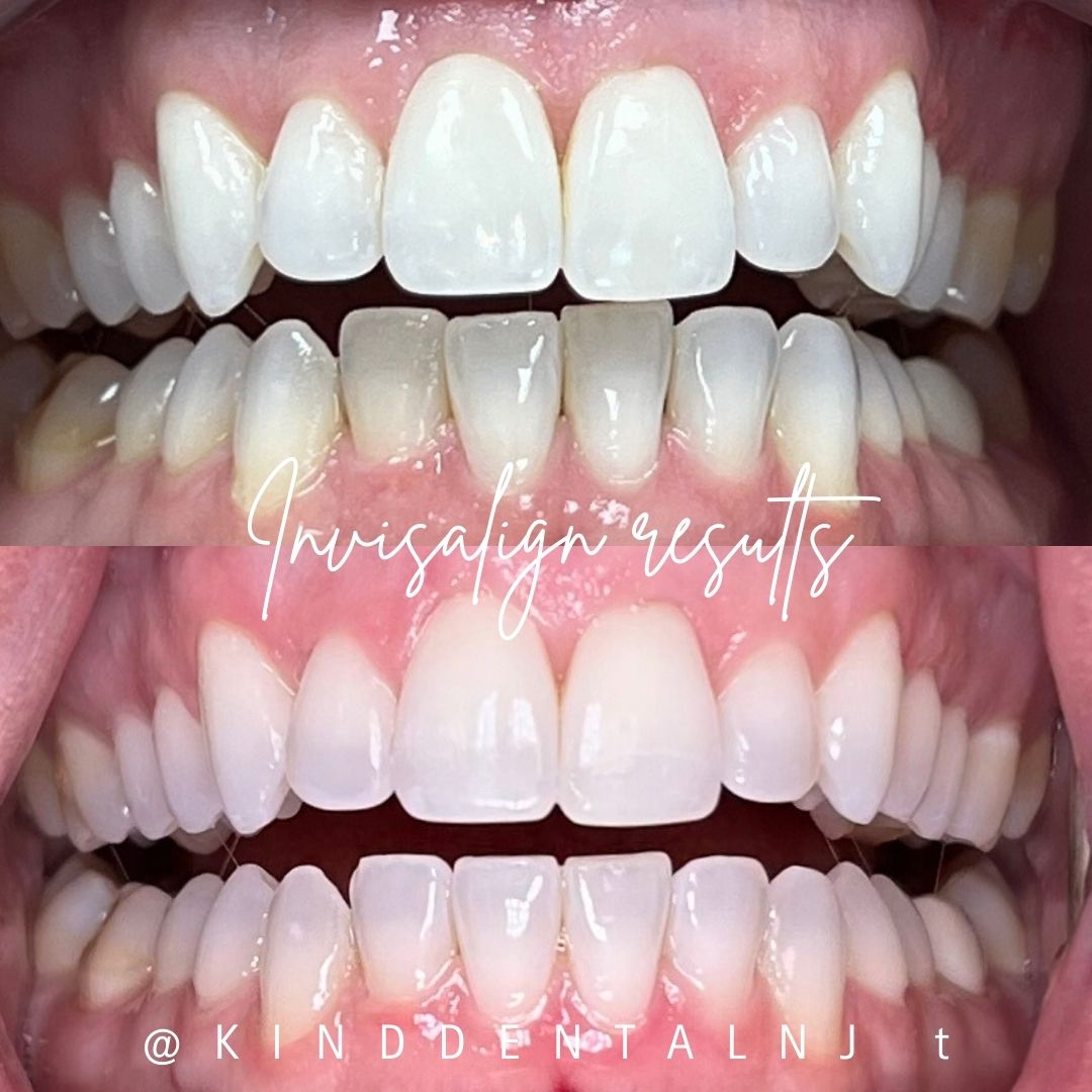 Kind Dental NJ - Kind Dental NJ Invisalign Kind Dental