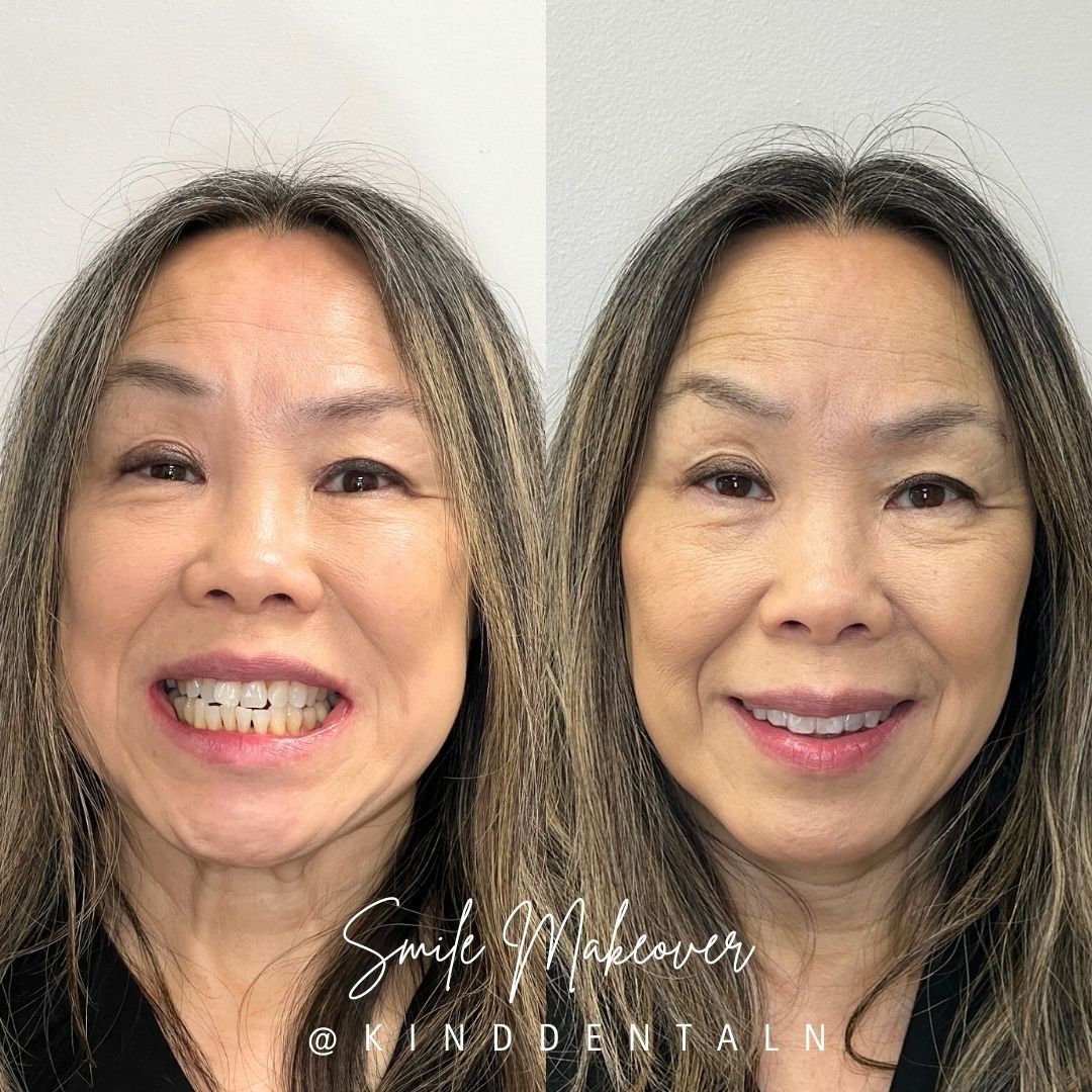 Kind Dental NJ - Kind Dental NJ Kind Dental B&A's for Website (6)